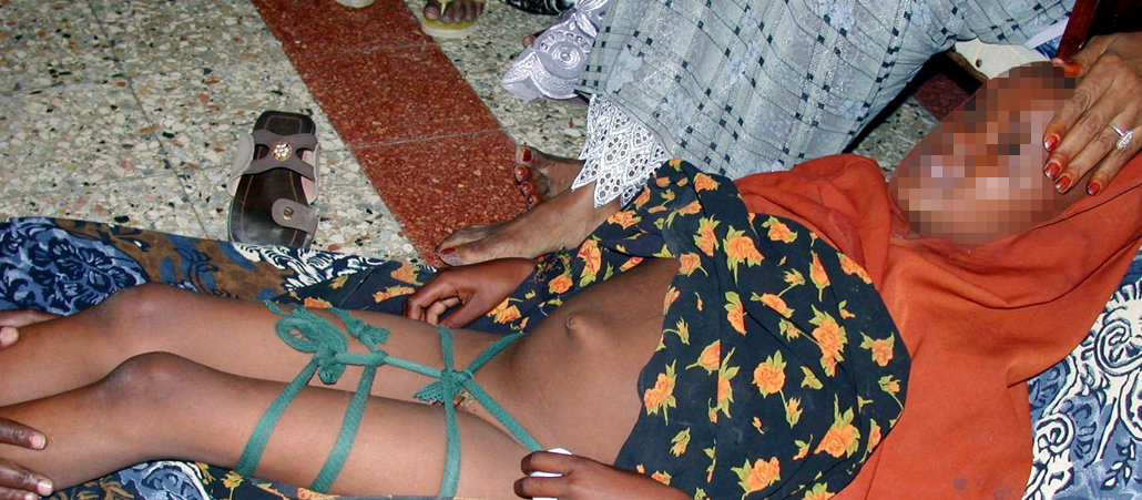 Beschneidung eines Mädchens in Somalia.