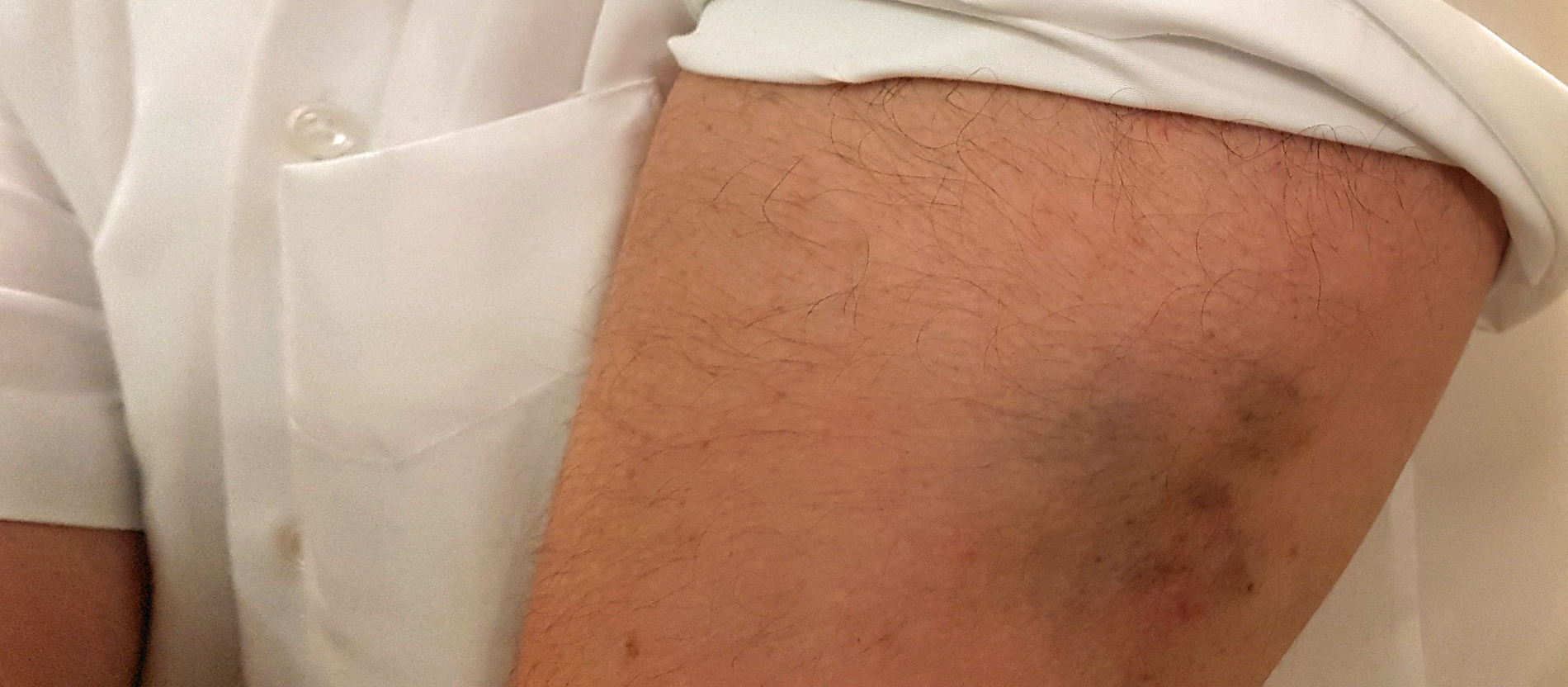 Stefan T. zeigt einen blauen Fleck